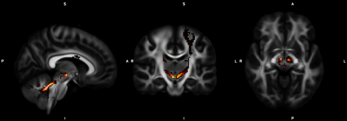 denticulorubrothalamic tract