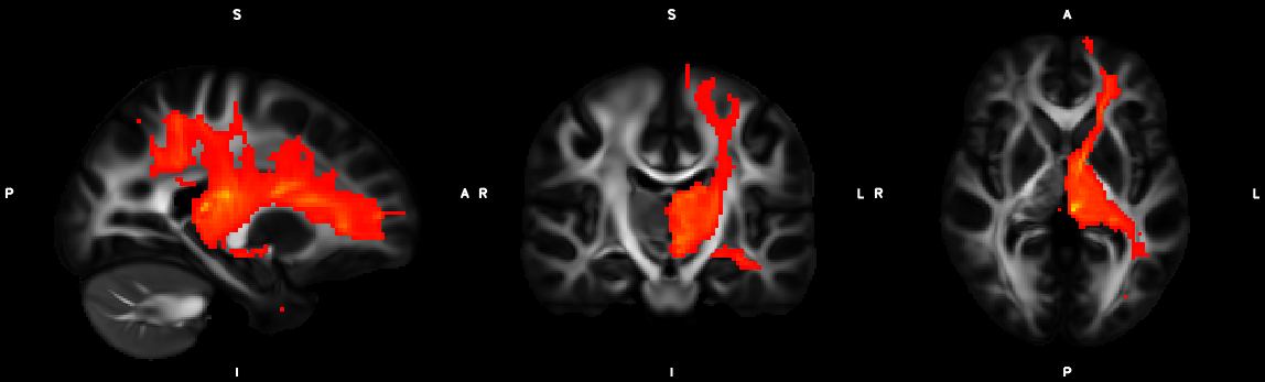 fdt_paths_thalamus