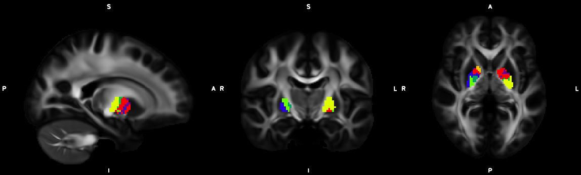 pallidal_segmentation_2methods